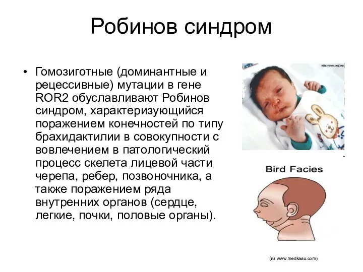 Робинов синдром Гомозиготные (доминантные и рецессивные) мутации в гене ROR2 обуславливают