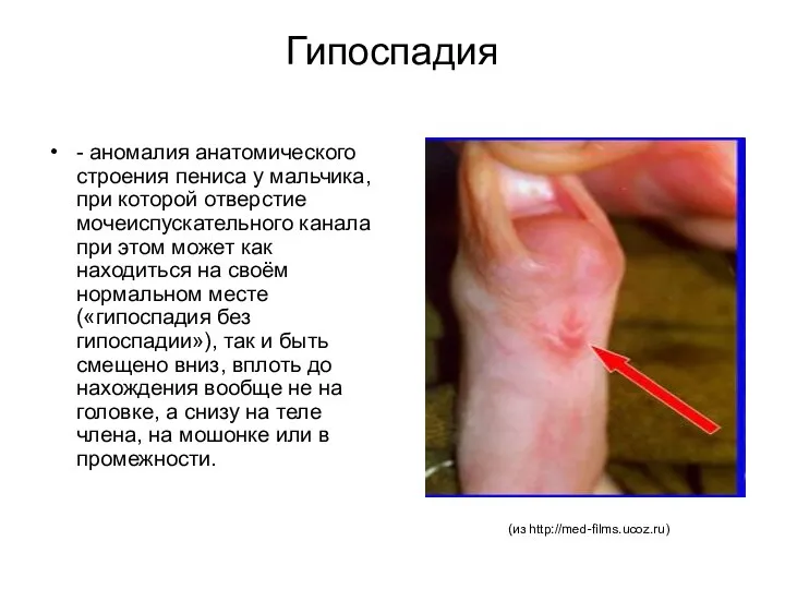 Гипоспадия - аномалия анатомического строения пениса у мальчика, при которой отверстие