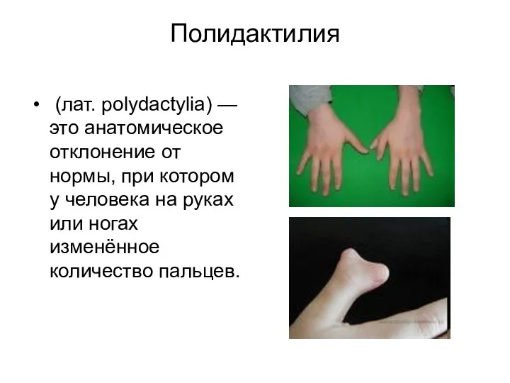 Полидактилия (лат. polydactylia) — это анатомическое отклонение от нормы, при котором
