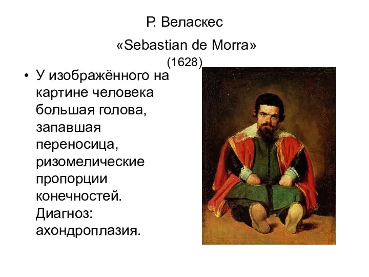 Р. Веласкес «Sebastian de Morra» (1628) У изображённого на картине человека