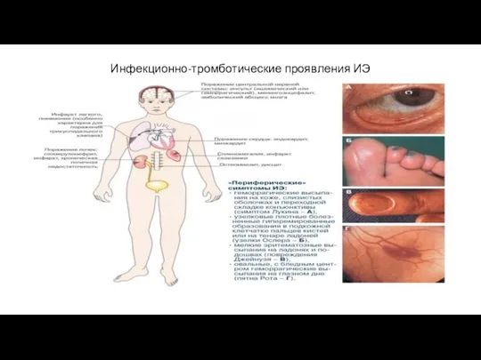 Инфекционно-тромботические проявления ИЭ