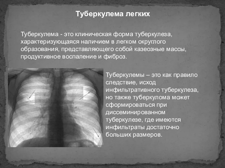 Туберкулема легких Туберкулема - это клиническая форма туберкулеза, характеризующаяся наличием в