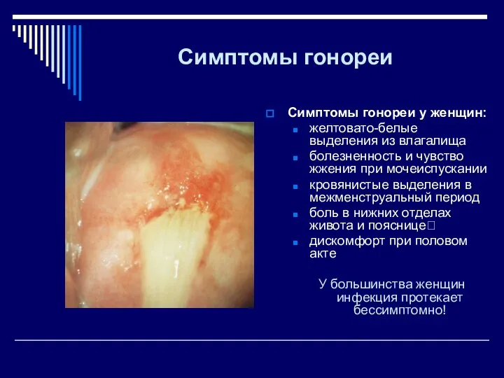 Симптомы гонореи Симптомы гонореи у женщин: желтовато-белые выделения из влагалища болезненность