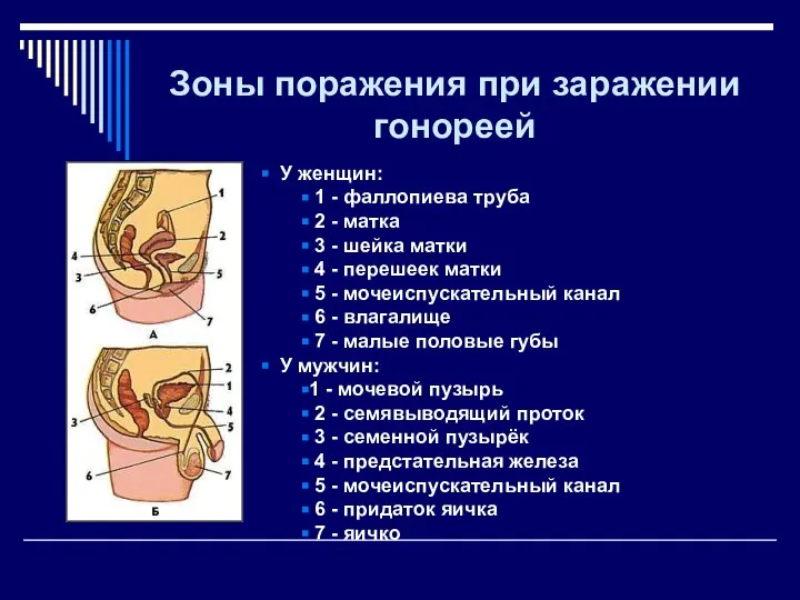 Зоны поражения при заражении гонореей У женщин: 1 - фаллопиева труба