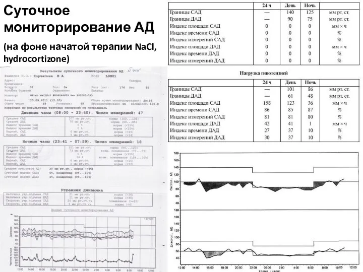 Суточное мониторирование АД (на фоне начатой терапии NaCl, hydrocortizone)