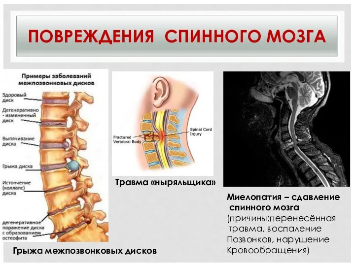 ПОВРЕЖДЕНИЯ СПИННОГО МОЗГА Травма «ныряльщика» Миелопатия – сдавление спинного мозга (причины:перенесённая