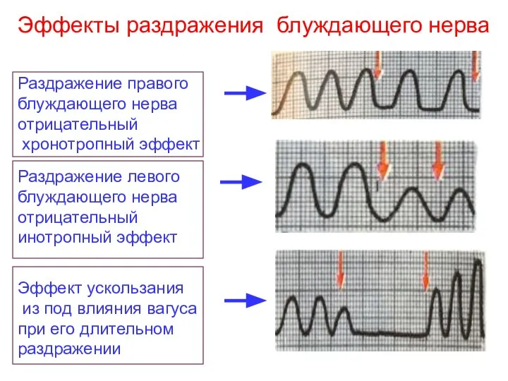 Эффекты раздражения блуждающего нерва Раздражение правого блуждающего нерва отрицательный хронотропный эффект