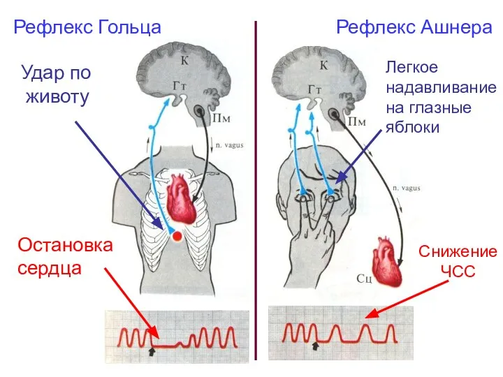 Рефлекс Гольца Рефлекс Ашнера Удар по животу Остановка сердца Легкое надавливание на глазные яблоки Снижение ЧСС