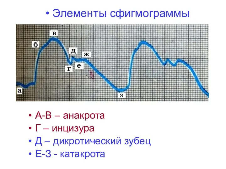 а, б, в, - повышение давления во время систолы в, г