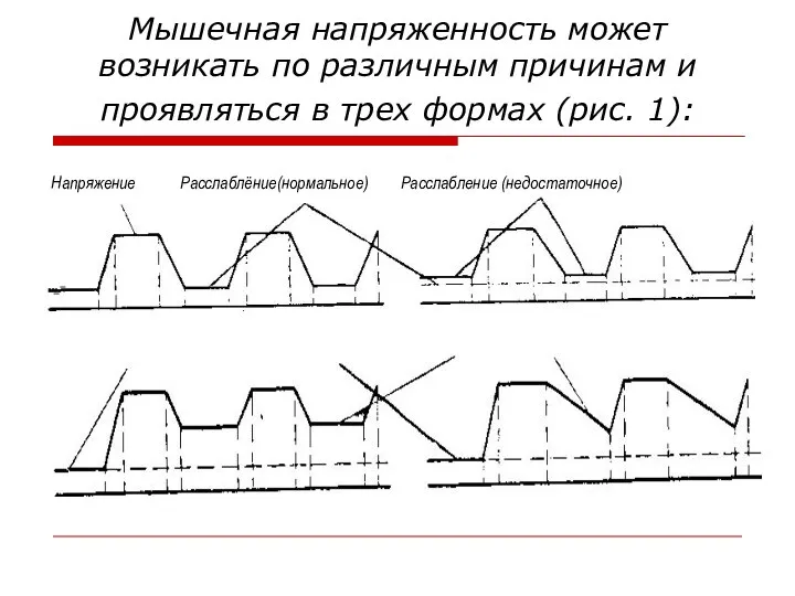 Мышечная напряженность может возникать по различным причинам и проявляться в трех формах (рис. 1):