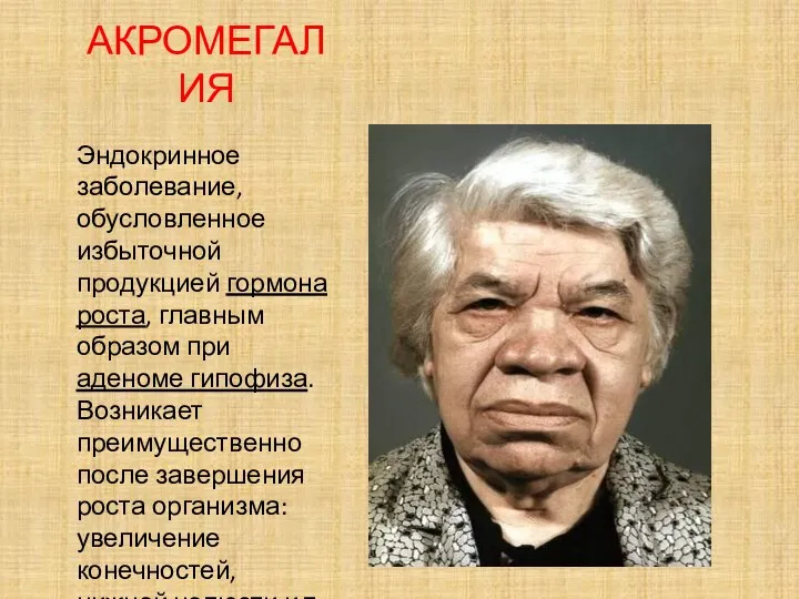 АКРОМЕГАЛИЯ Эндокринное заболевание, обусловленное избыточной продукцией гормона роста, главным образом при