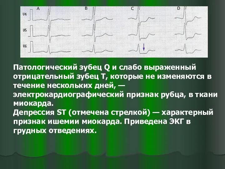 Патологический зубец Q и слабо выраженный отрицательный зубец T, которые не