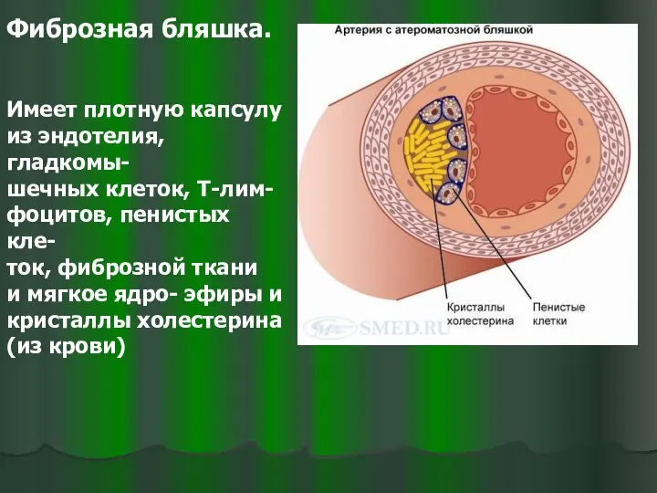 Фиброзная бляшка. Имеет плотную капсулу из эндотелия, гладкомы- шечных клеток, Т-лим-