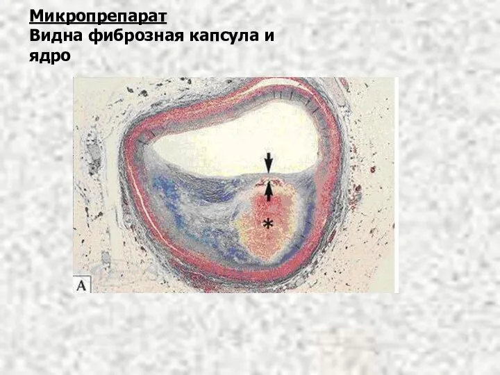 Микропрепарат Видна фиброзная капсула и ядро