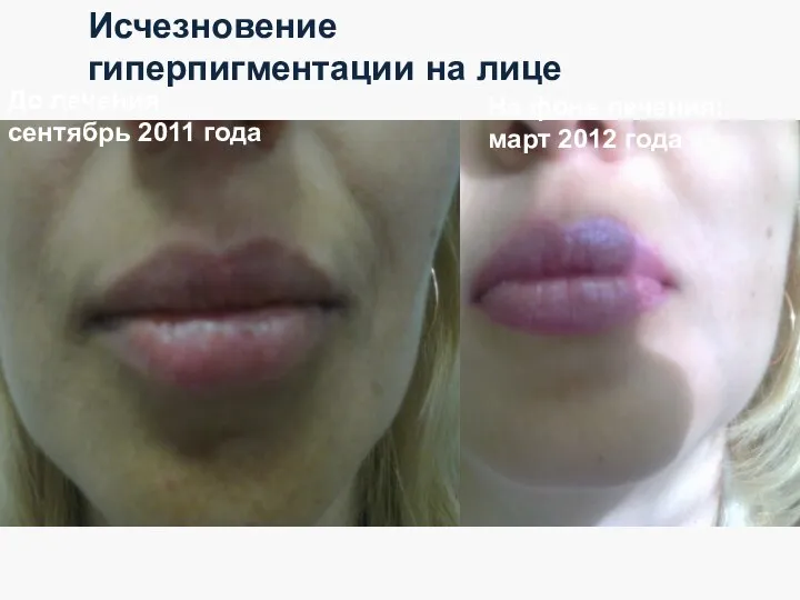До лечения: сентябрь 2011 года На фоне лечения: март 2012 года Исчезновение гиперпигментации на лице