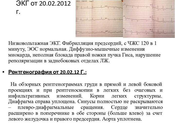 ЭКГ от 20.02.2012 г. Низковольтажная ЭКГ. Фибрилляция предсердий, с ЧЖС 120