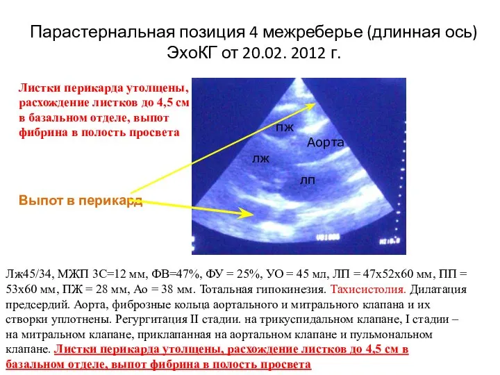 Парастернальная позиция 4 межреберье (длинная ось) ЭхоКГ от 20.02. 2012 г.