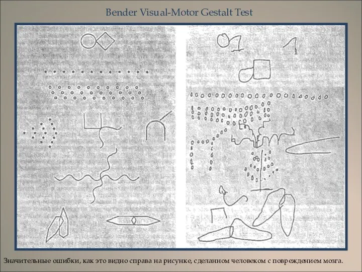 Bender Visual-Motor Gestalt Test Значительные ошибки, как это видно справа на