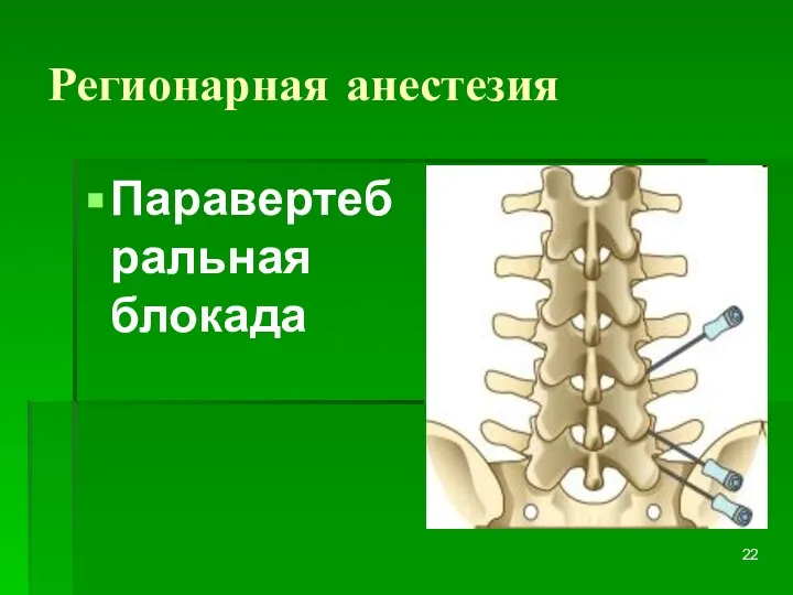 Регионарная анестезия Паравертебральная блокада