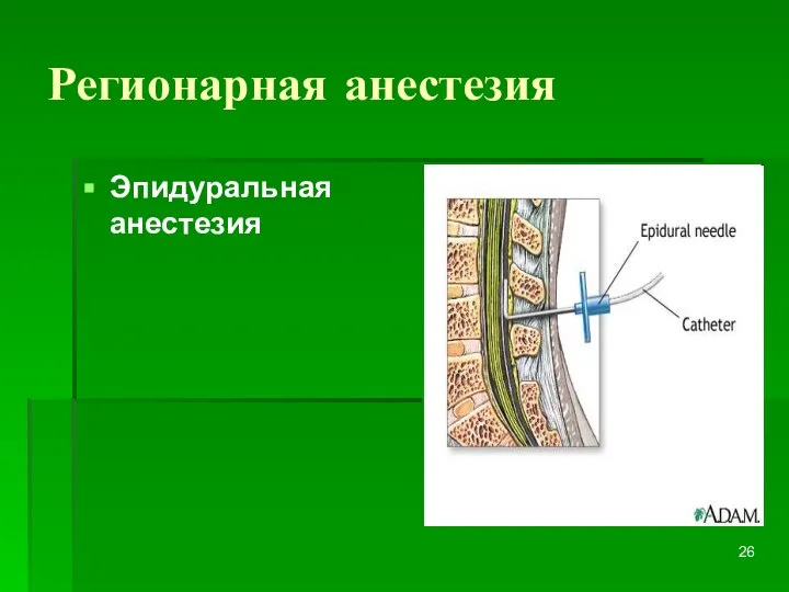 Регионарная анестезия Эпидуральная анестезия