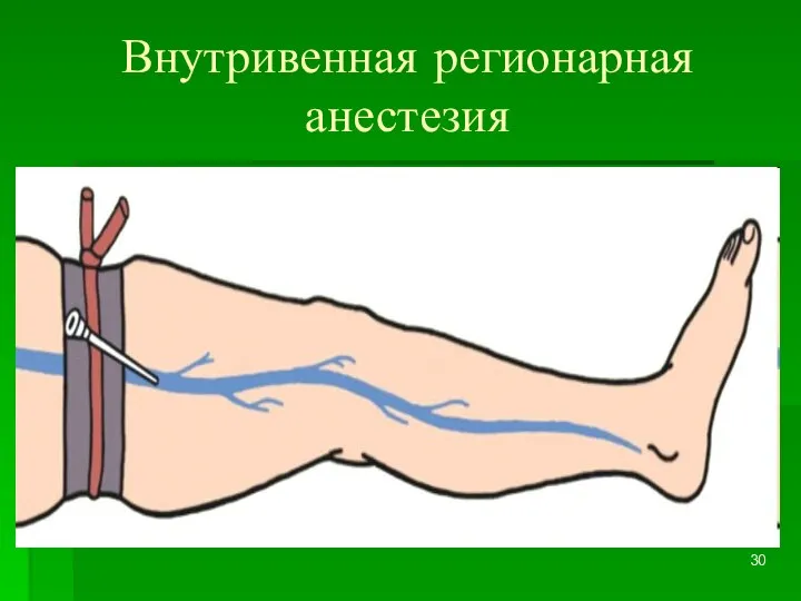 Внутривенная регионарная анестезия