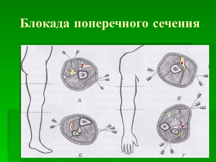 Блокада поперечного сечения