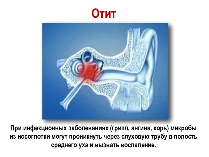 Отит При инфекционных заболеваниях (грипп, ангина, корь) микробы из носоглотки могут