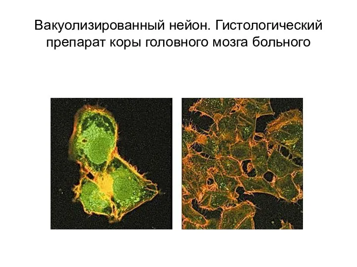 Вакуолизированный нейон. Гистологический препарат коры головного мозга больного