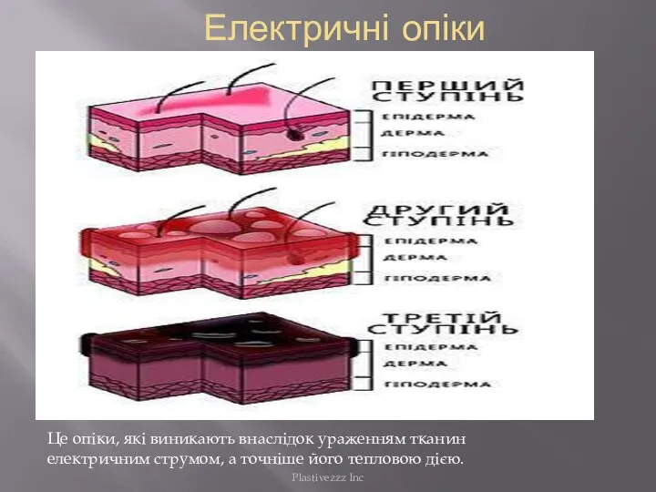 Електричні опіки Це опіки, які виникають внаслідок ураженням тканин електричним струмом,