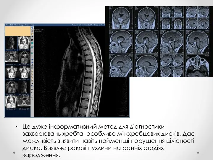 Це дуже інформативний метод для діагностики захворювань хребта, особливо міжхребцевих дисків.