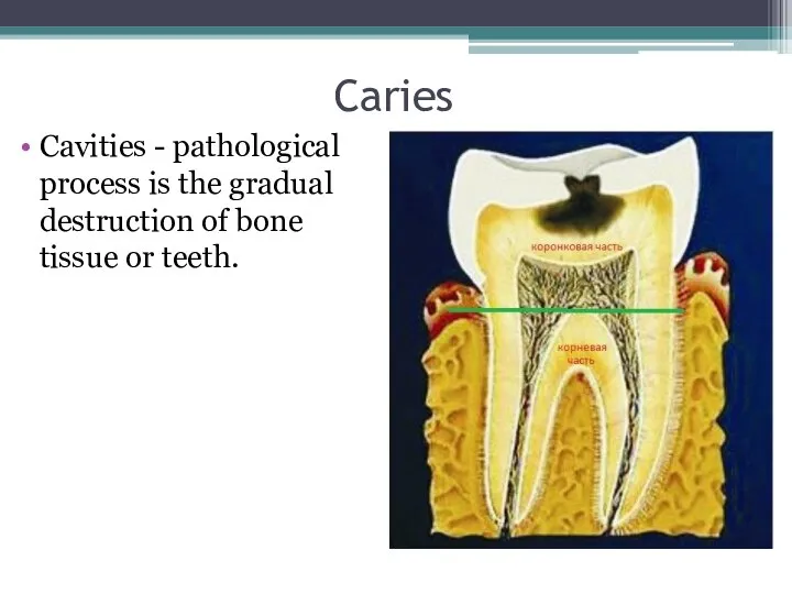 Caries Cavities - pathological process is the gradual destruction of bone tissue or teeth.
