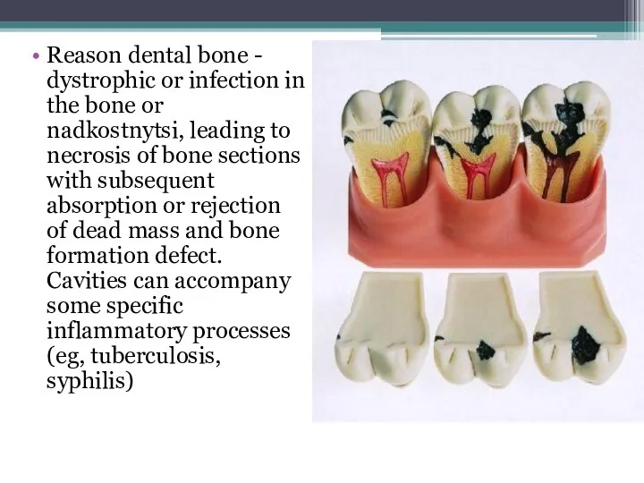 Reason dental bone - dystrophic or infection in the bone or