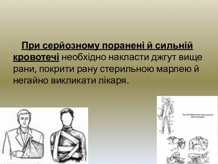 При серйозному поранені й сильній кровотечі необхідно накласти джгут вище рани,