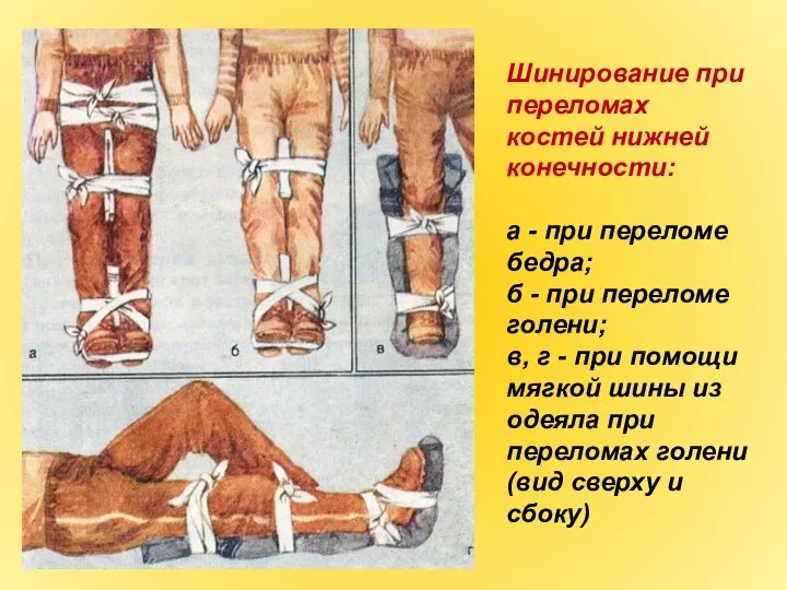 Шинирование при переломах костей нижней конечности: а - при переломе бедра;