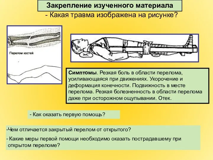 - Какая травма изображена на рисунке? Чем отличается закрытый перелом от