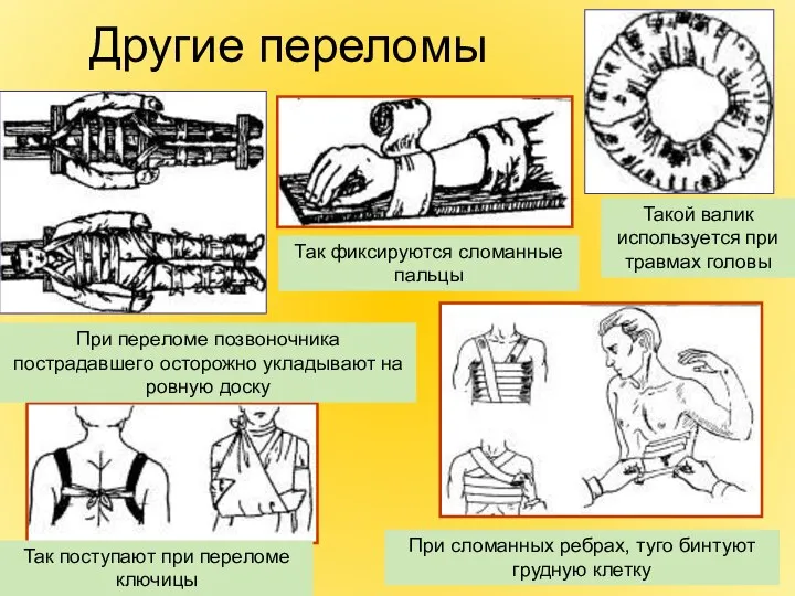 Другие переломы Такой валик используется при травмах головы Так фиксируются сломанные