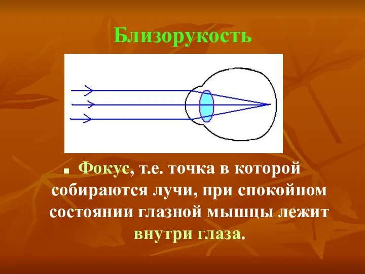 Близорукость Фокус, т.е. точка в которой собираются лучи, при спокойном состоянии глазной мышцы лежит внутри глаза.