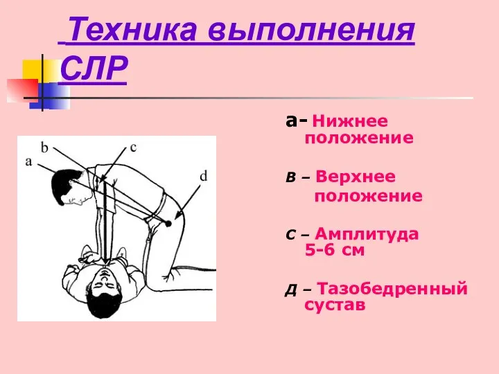 Техника выполнения СЛР а- Нижнее положение В – Верхнее положение С