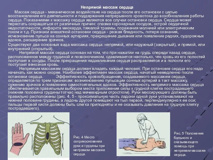 Непрямой массаж сердца Массаж сердца - механическое воздействие на сердце после