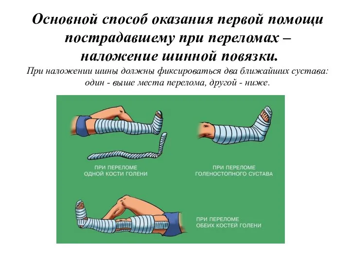 Основной способ оказания первой помощи пострадавшему при переломах – наложение шинной