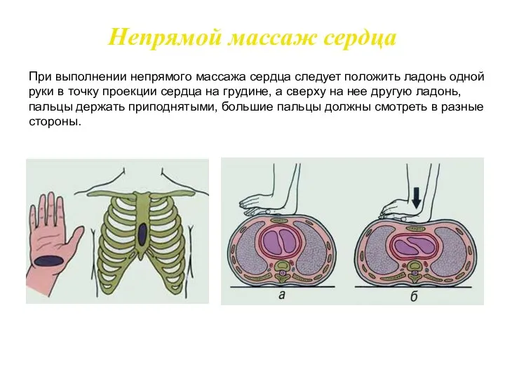 При выполнении непрямого массажа сердца следует положить ладонь одной руки в