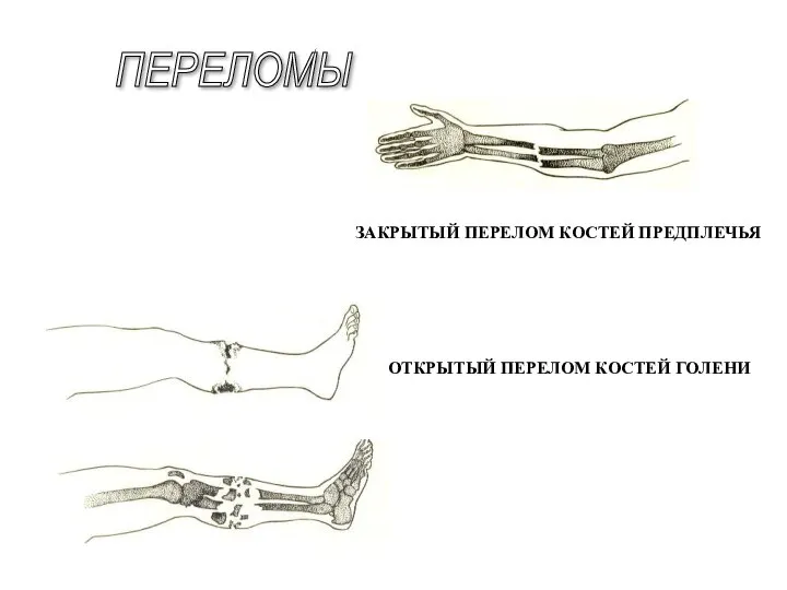 ЗАКРЫТЫЙ ПЕРЕЛОМ КОСТЕЙ ПРЕДПЛЕЧЬЯ ОТКРЫТЫЙ ПЕРЕЛОМ КОСТЕЙ ГОЛЕНИ ПЕРЕЛОМЫ