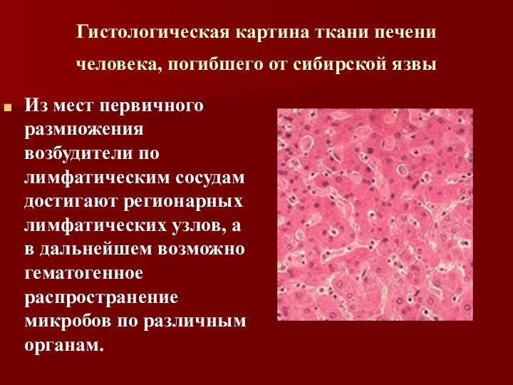 Гистологическая картина ткани печени человека, погибшего от сибирской язвы Из мест