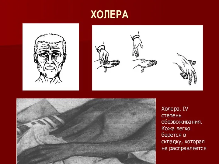 ХОЛЕРА Холера, IV степень обезвоживания. Кожа легко берется в складку, которая не расправляется