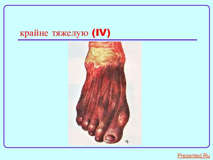 крайне тяжелую (IV) Prezented.RuPrezented.Ru