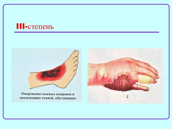 III-степень