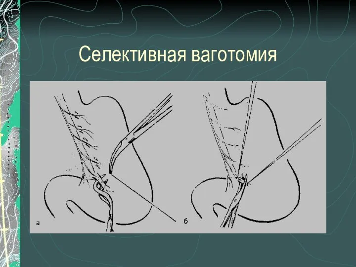 Селективная ваготомия