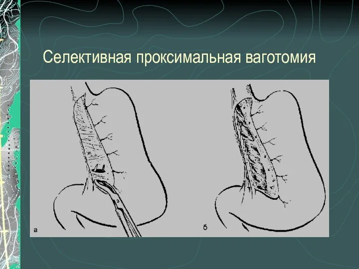 Селективная проксимальная ваготомия