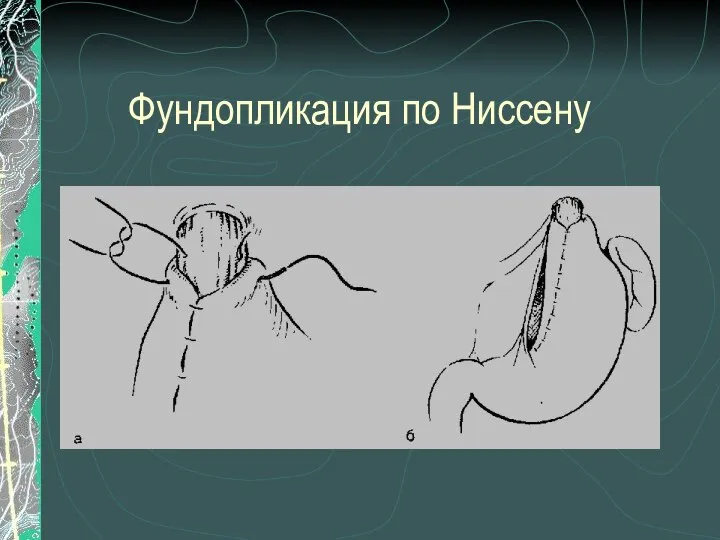 Фундопликация по Ниссену