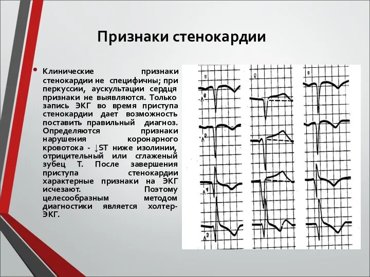 Признаки стенокардии Клинические признаки стенокардии не специфичны; при перкуссии, аускультации сердця